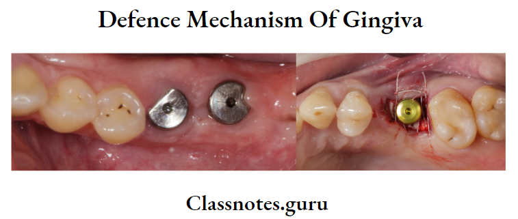 Defence Mechanism Of Gingiva Gingival Crevicular Fluid