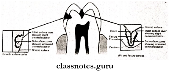Dental Caries Caries Magnified Schematic Presentation Of Smooth Surface Caries