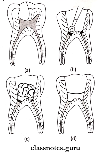 Dental Caries Method Of Performing pulpotomy