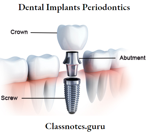 Dental Implants Periodontics Structure Of Dental Implants