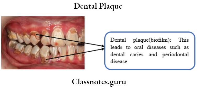 Dental Plaque Dental Plaque Of Biofilm