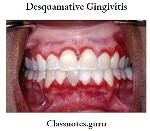 Desquamative Gingivitis Structure of Desquamative Gingivitis