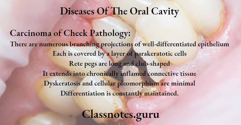 Diseases Of The Oral Cavity Carcinoma of Cheek Pathology