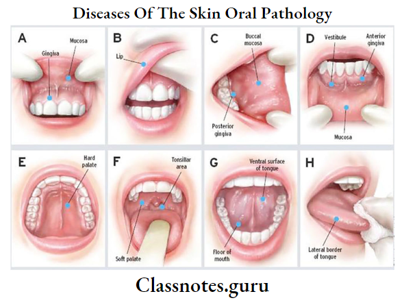 Diseases Of The Skin Oral Pathology