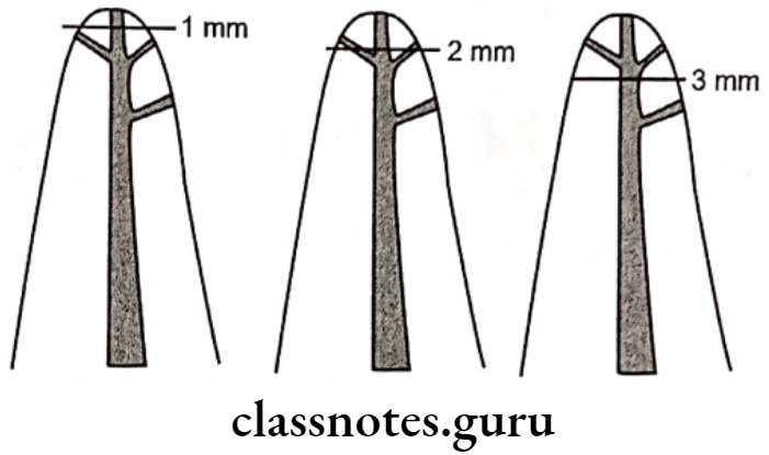 Endodontics Miscellaneous Frequency of canals found at different levels of root canals