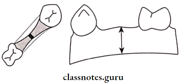 Fixed Partial Denture Class 1 Residual Ridge