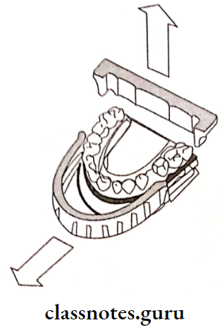Fixed Partial Denture D Lok Tray