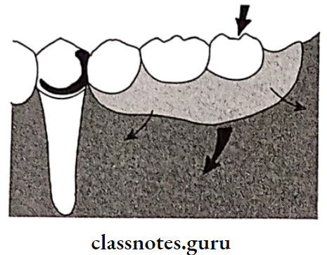 Fixed Partial Denture Removal Partial Denture