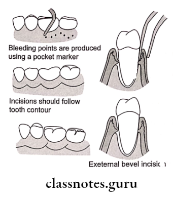 Gingivectomy Steps in gingivectomy