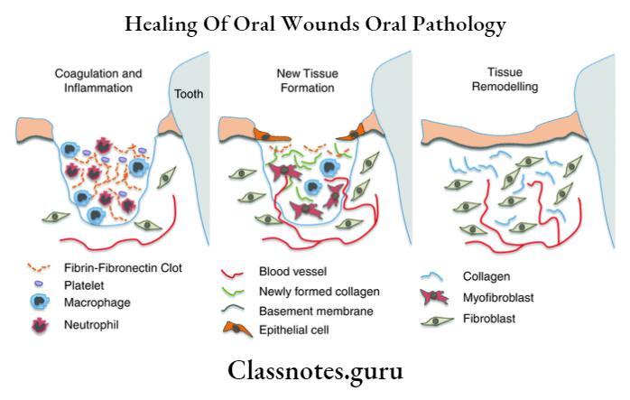 Healing Of Oral Wounds Oral Pathology