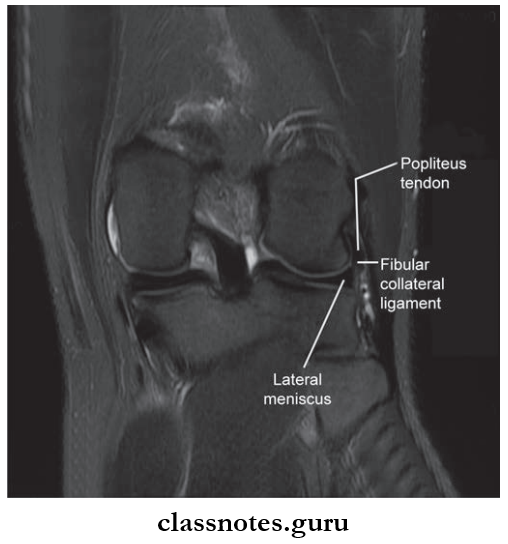 Joints Of Lower Limb MRI Of Coronal View Of Knee Showing Fibular Collateral Ligament