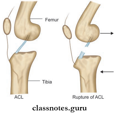 Joints Of Lower Limb Positive Anterior Drawer Sign In Rupture Of Anterior Cruciate Ligament