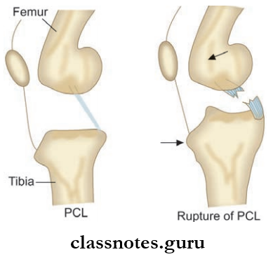 Joints Of Lower Limb Positive Posterior Drawer Sign In Rupture Of Posterior Cruciate Ligament