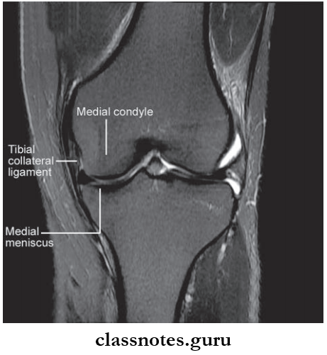 Joints Of Lower Limb Tibial Collateral Ligament And Medial Meniscus In MRI Of Knee In Coronal Plane