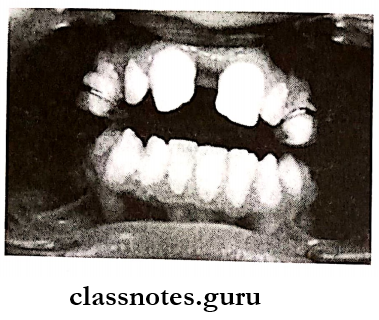 Malocclusions Midline diastema produced during rapid maxillary expansion