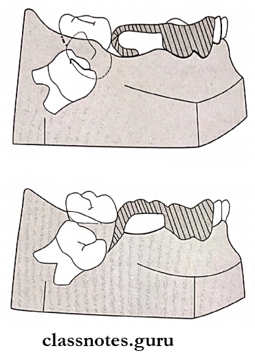Malocclusions Modification of distal shoe space maintainer