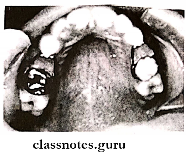 Malocclusions Space maintained for missing primary first molars using crown and loop on the left side, band and loop on the right