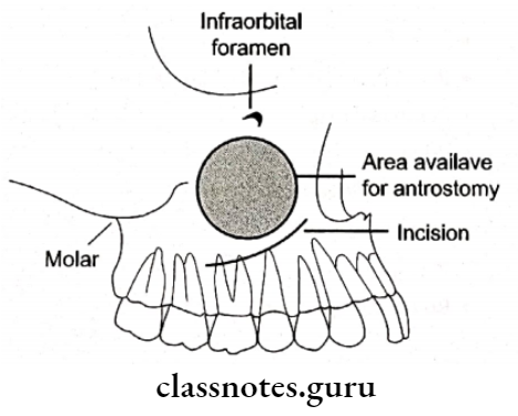 Maxillary Sinus And Its Implications Caldwelluc Operation
