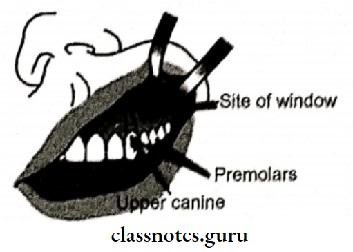 Maxillary Sinus And Its Implications Caldwelluc Procedure