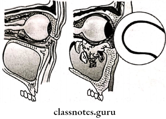 Maxillofacial Trauma Blow Out Fracture Of the Floor Of The Orbit
