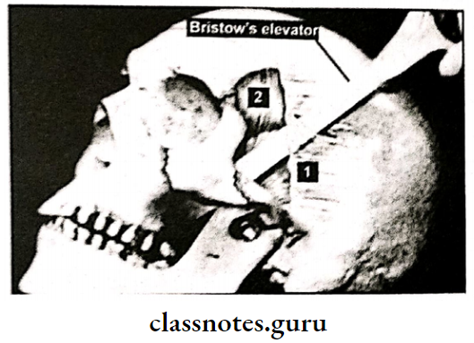 Maxillofacial Trauma Gillies Temporal Approach For Reduction Of Zygomatic Bone Arch Fracture