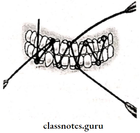 Maxillofacial Trauma Ivy Eyelats Wiring The Arrangement Of Tie wires In V Parttern