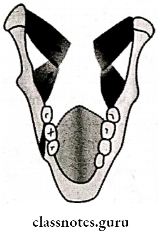 Maxillofacial Trauma Vertically Favourable Line Of Fracture Right angle Of The Mandible