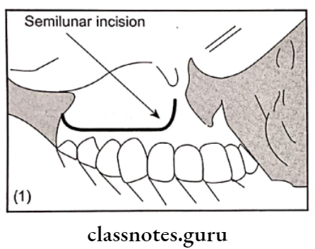 Miscellaneous Intraoral Incision Of Cald Well Luc
