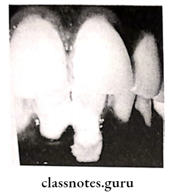 Mucogingival Surgery Localized recession