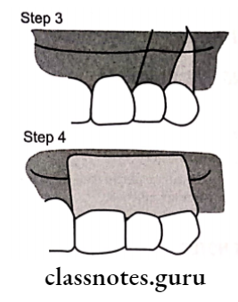 Mucogingival Surgery Various steps in laterally position flap.