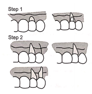 Mucogingival Surgery Various steps in laterally position flap