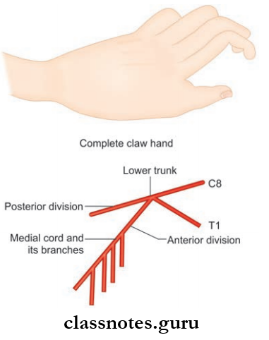 Nerves Of Upper Limb Claw-hand Deformity Due To Lesion Of Lower Trunk Of Brachial Plexus
