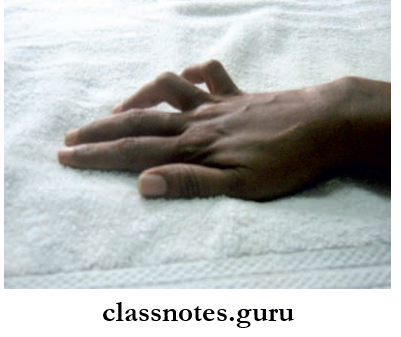 Nerves Of Upper Limb Ulnar Claw Hand