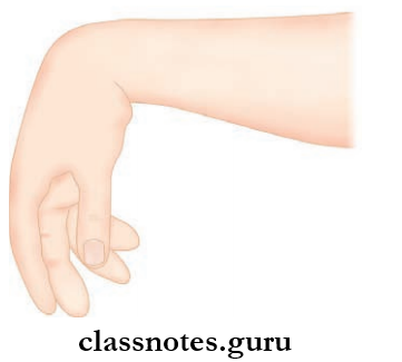 Nerves Of Upper Limb Wrist Drop Due To Inaction Of Carpal Extensor Muscles
