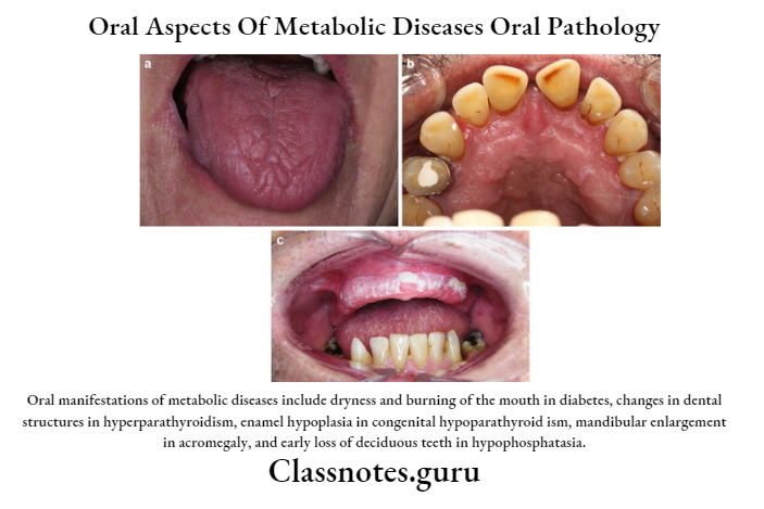Oral Aspects Of Metabolic Diseases Oral Pathology