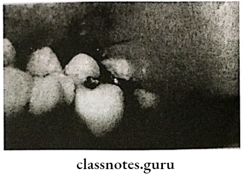 Orofacial And Neck Infections Pericoronitis Third molar Partially