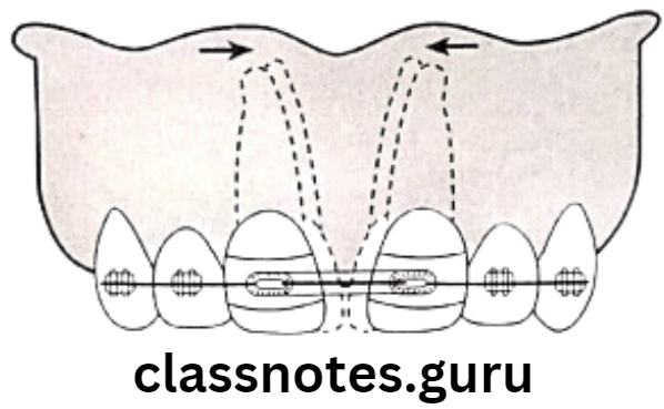 Orthodontics Anchorage Correction of midline diastema using elastics