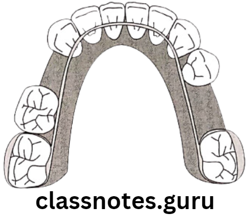Orthodontics Anchorage Lingual arch