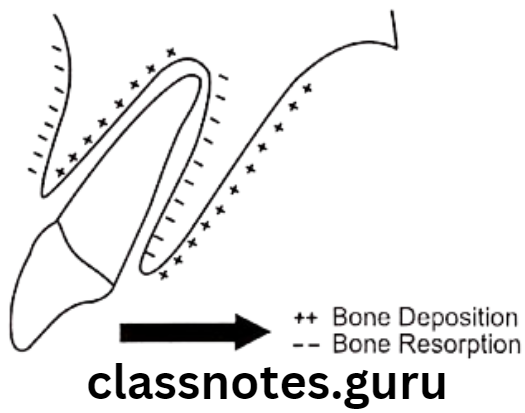 Orthodontics Biology Of Tooth Movement Secondary remodeling changes seen Bone Deposition and Bone Resorption 1
