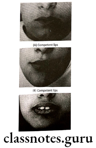 Orthodontics Cephalometrics Tweed Analysis