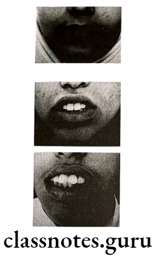 Orthodontics Cephalometrics Assessment of the lips 2