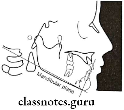 Orthodontics Cephalometrics Incisor mandibular plane angle