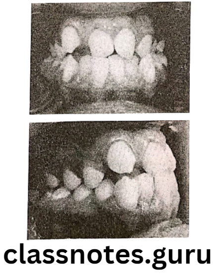 Orthodontics Classification Of Malocclusion Crowding