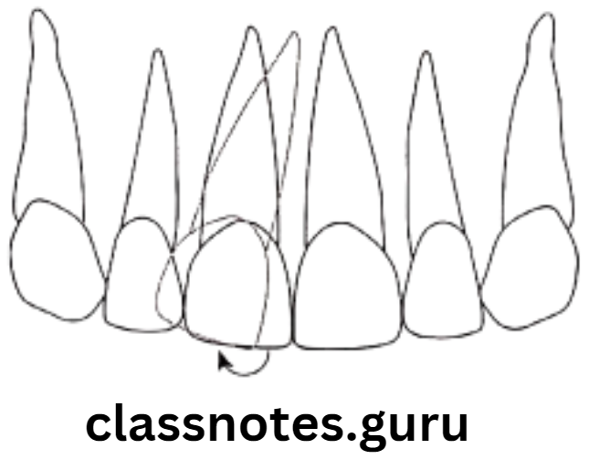 Orthodontics Classification Of Malocclusion Distal tipping