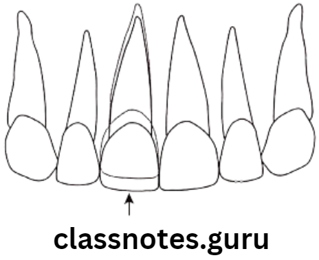 Orthodontics Classification Of Malocclusion Infra occlusion