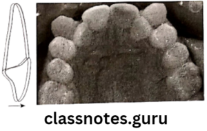Classification Of Malocclusion Question And Answers - Class Notes