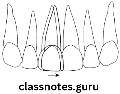 Orthodontics Classification Of Malocclusion Mesial displacement