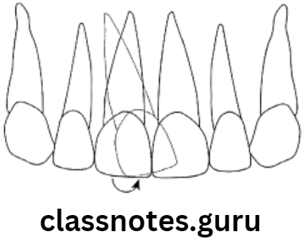Orthodontics Classification Of Malocclusion Mesial tipping