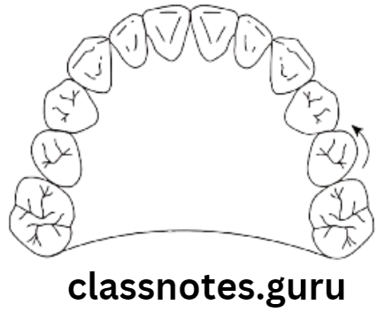 Orthodontics Classification Of Malocclusion Mesio lingual rotation
