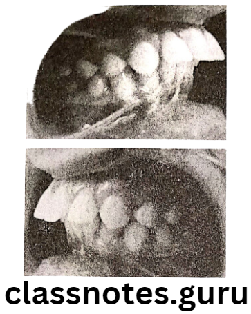 Orthodontics Classification Of Malocclusion Proclination of the upper arch